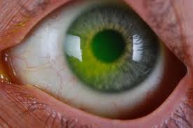 Cornea Heal After LASIK