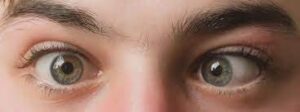 Lasik Fix Lazy Eyes
