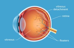 Eye Floaters and Retinal Tear