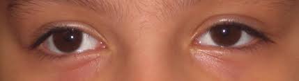 Lasik Surgery Cure Exotropia