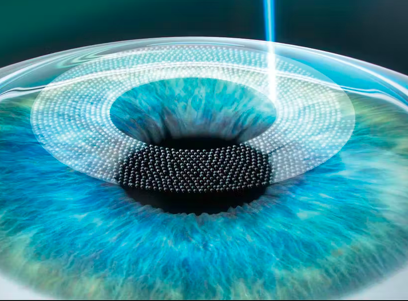 How Long Does LASIK Last?