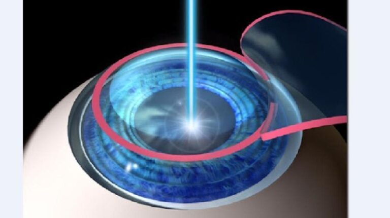 Femto Lasik and Corneal Crosslinking (C3r)