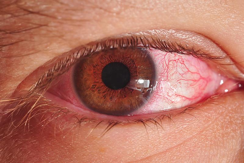 Red Eye After Lasik