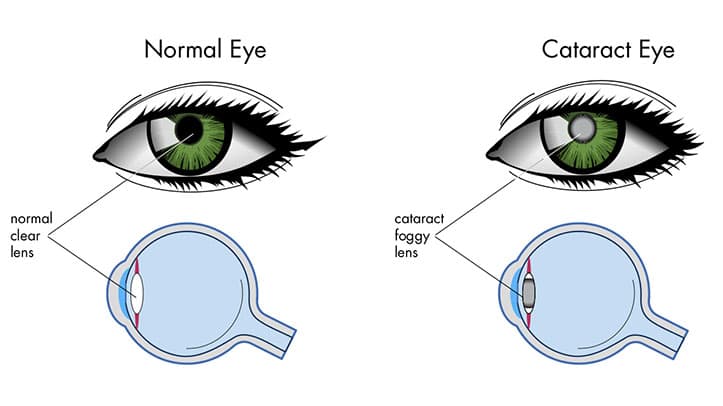 LASIK Surgery Correct Cataracts