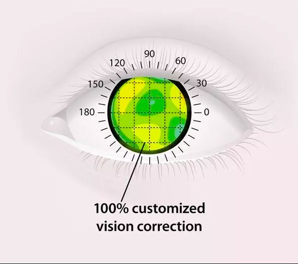How Much Does Contoura Vision Surgery Cost In Delhi? – LOAG