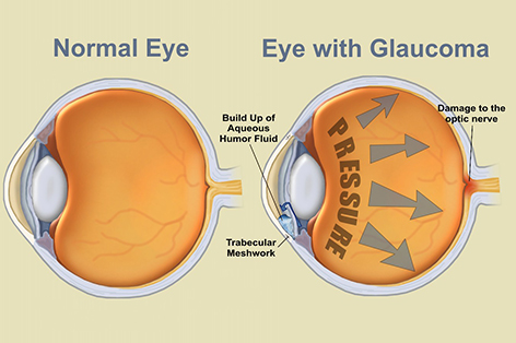 Glaucoma Be Fixed With LASIK Surgery