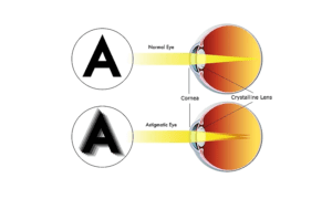 Lasik Cure Astigmation