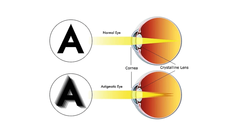 Lasik Cure Astigmation