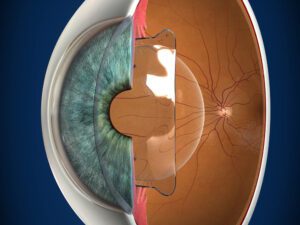 LASIK For Farsightedness