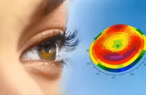 Difference Between Contoura Vision And Lasik Surgery