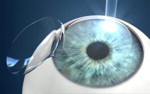 इसरो में LASIK