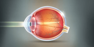 उच्च निकट दृष्टि दोष के लिए LASIK