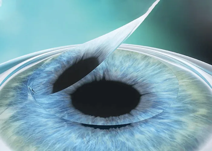 Flap Created During Lasik Surgery