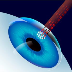 Success Rate Of Contoura Laser Eye Surgery