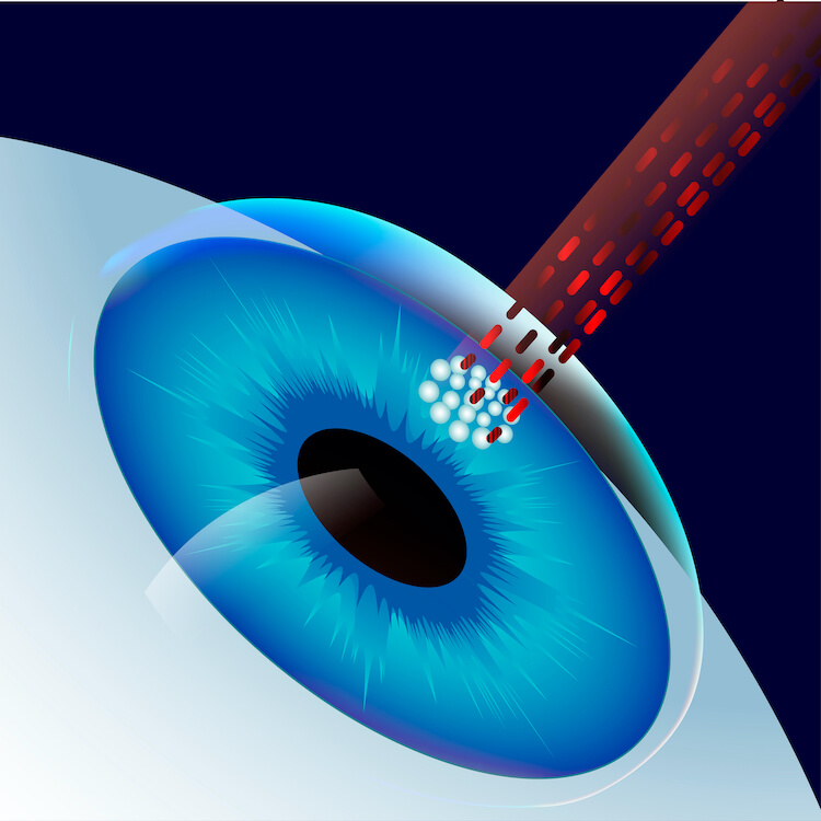 Success Rate Of Contoura Laser Eye Surgery