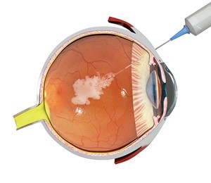 Can Lasik Surgery Fix Macular Degeneration