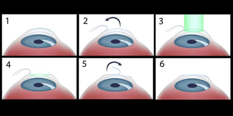 Process Of LASIK Eye Surgery