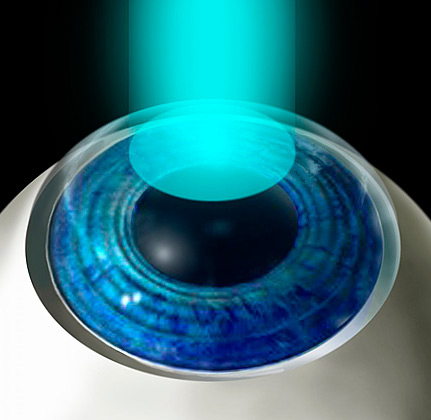 Ultraviolet Rays Used In Lasik Eye Surgery
