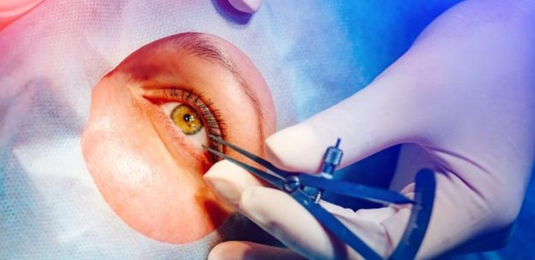 Is LASIK Surgery Safe