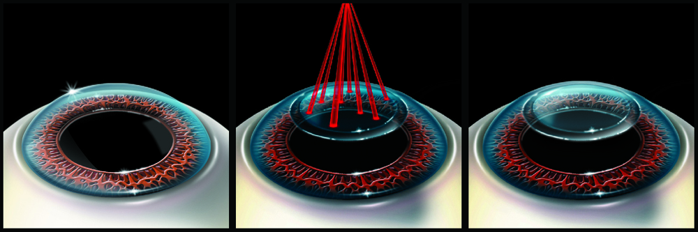 Is TransPRK A Permanent Solution For Vision Correction