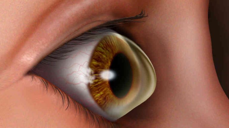 can keratoconus be cured