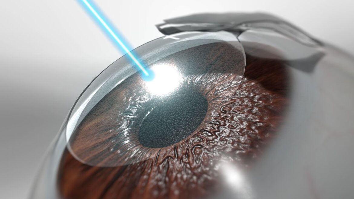 Can You Get Lasik with Nystagmus?
