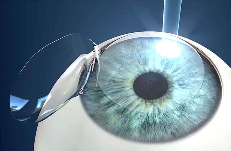 Lasik treatment for dry eyes syndrome