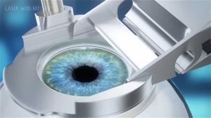 How long to use artificial tears after Lasik?