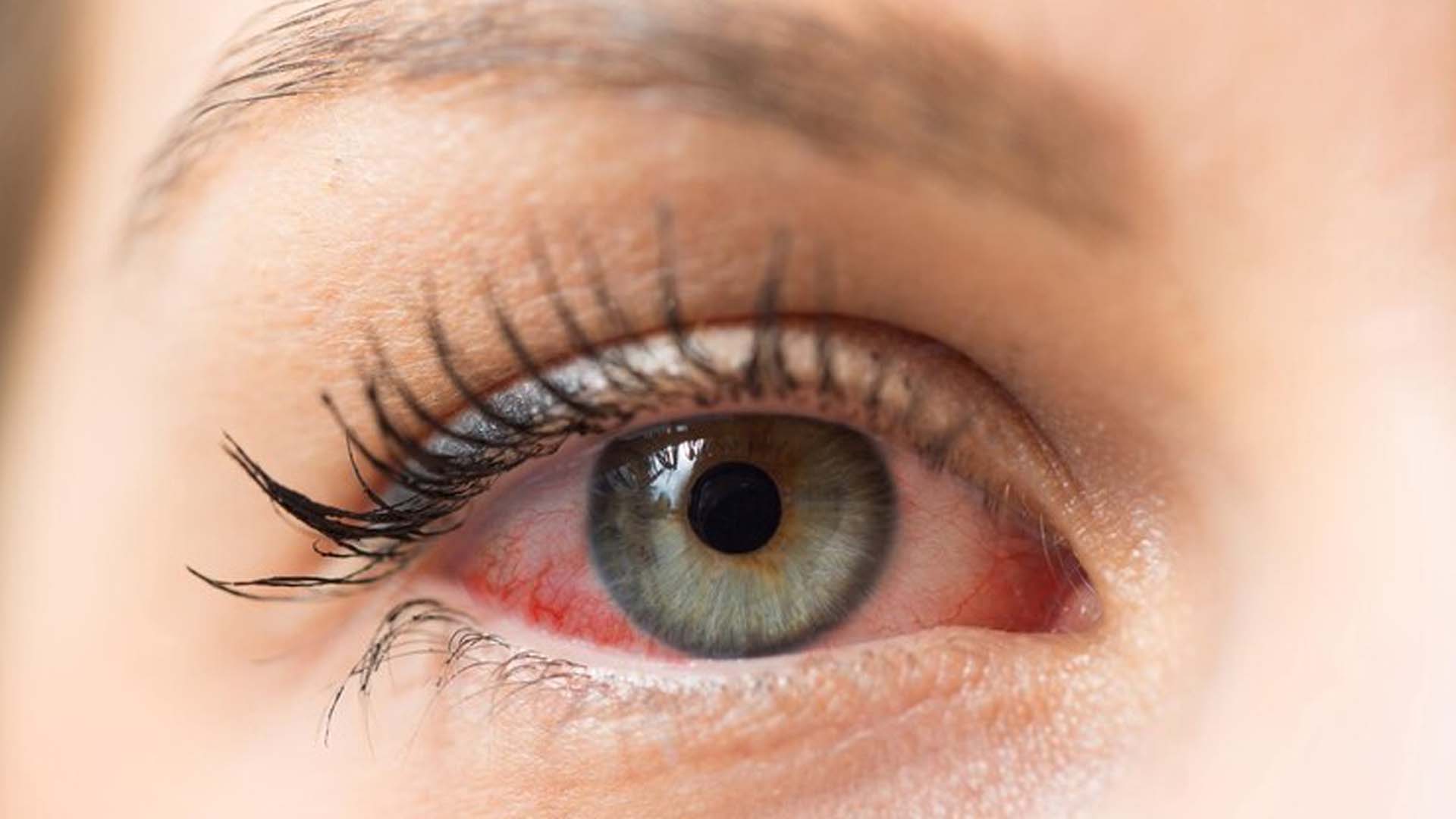 Can You Get Lasik with Graves Disease?