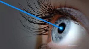 is lasik surgery allowed in the capf