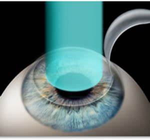 Is LASIK Covered Under CGHS?