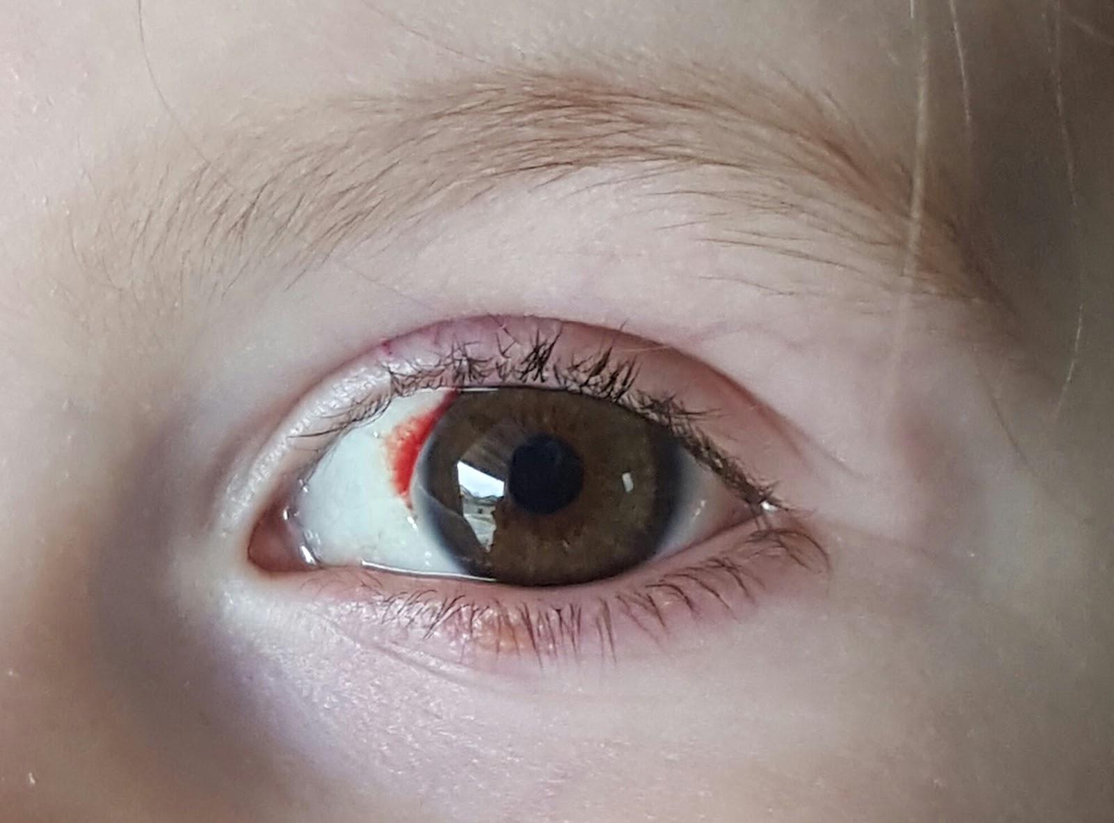 Double Vision After Squint Surgery