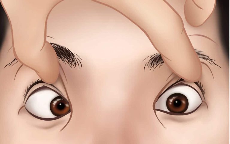 Squint Eye Treatment in Adults