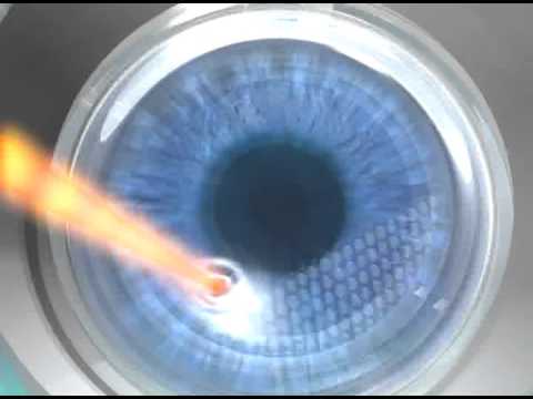 can you wear contacts ten years after lasik