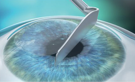 Does Blue Cross Blue Shield Cover Lasik's Eye Surgery?