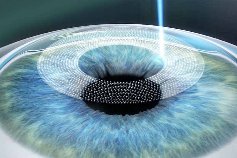 Can You Get Lasik If You Have Astigmatism?