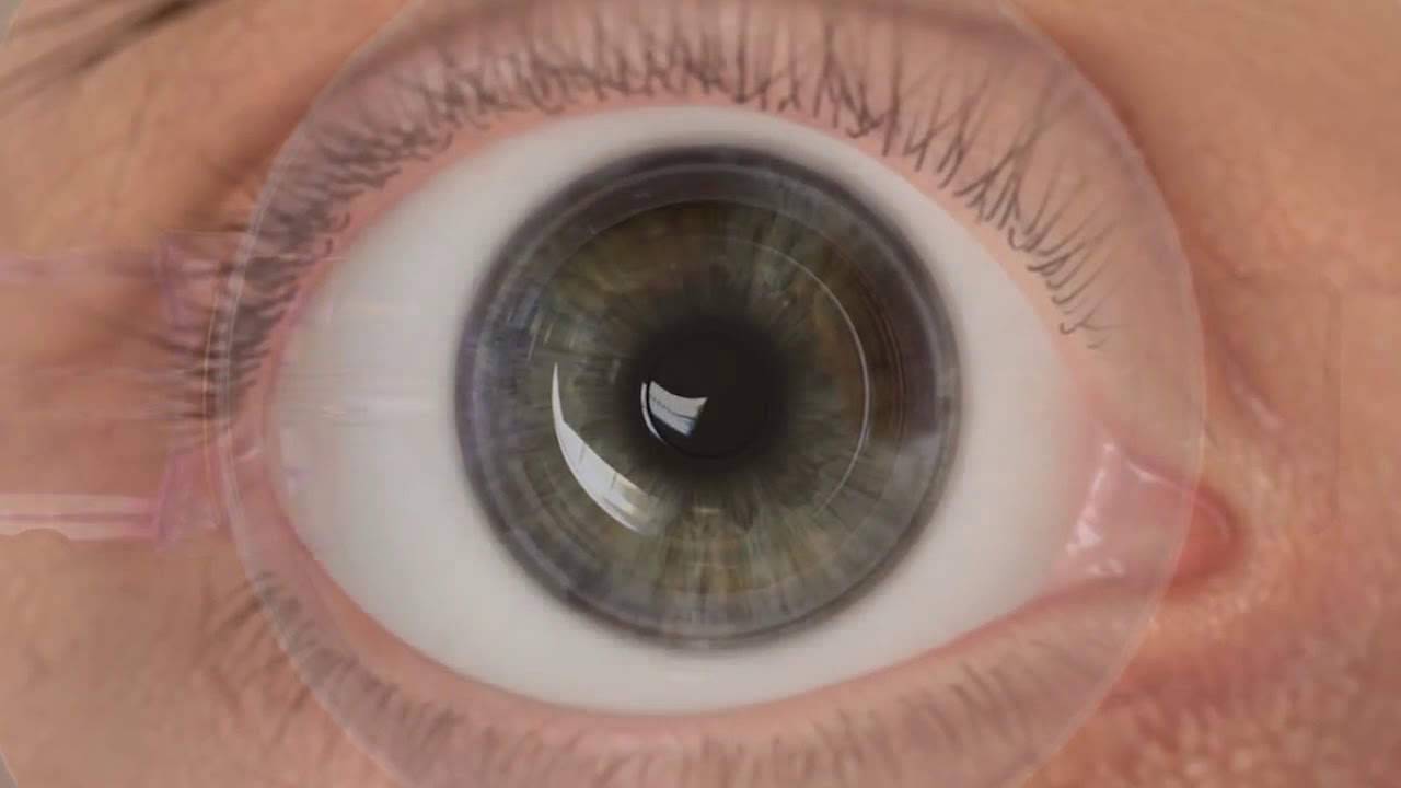 Dos and Don'ts After Laser Eye Surgery