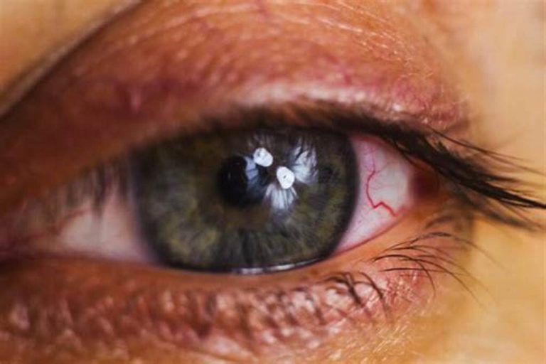 does silk eye surgery last forever