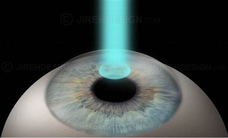 is silk eye surgery fda approved