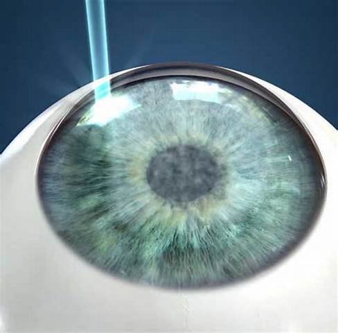 is silk eye surgery robotic