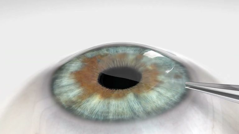 does smile pro surgery reshape the cornea