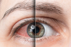 what is the success rate of silk eye surgery