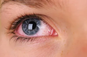 is silk eye procedure dangerous