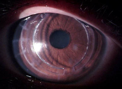 cataract surgery after lasik calculator