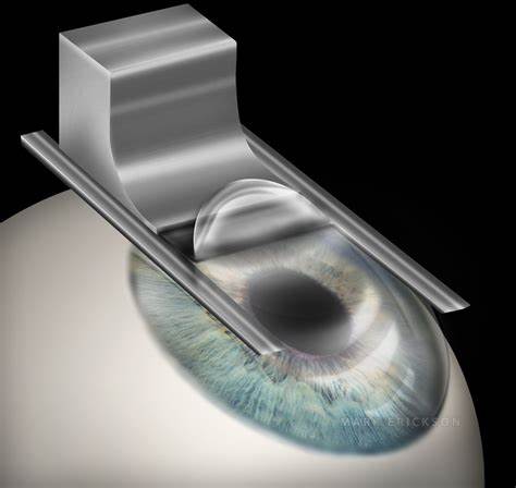 how long does eye surgery take to heal