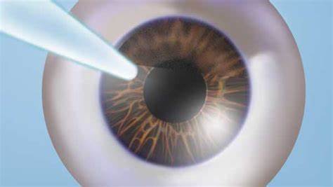 lasik flap dislocation treatment