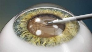 diabetic retinopathy: laser treatment recovery time