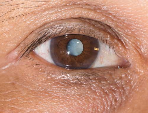 cataracts after lasik warning