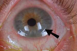 Lasik flap complications