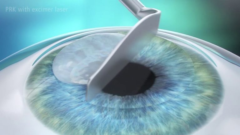 lasik flap dislocation treatment